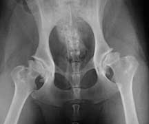 Hip Dysplasia