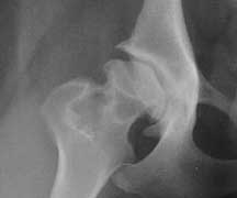 Hip Dysplasia Side View 