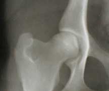 Normal Hip